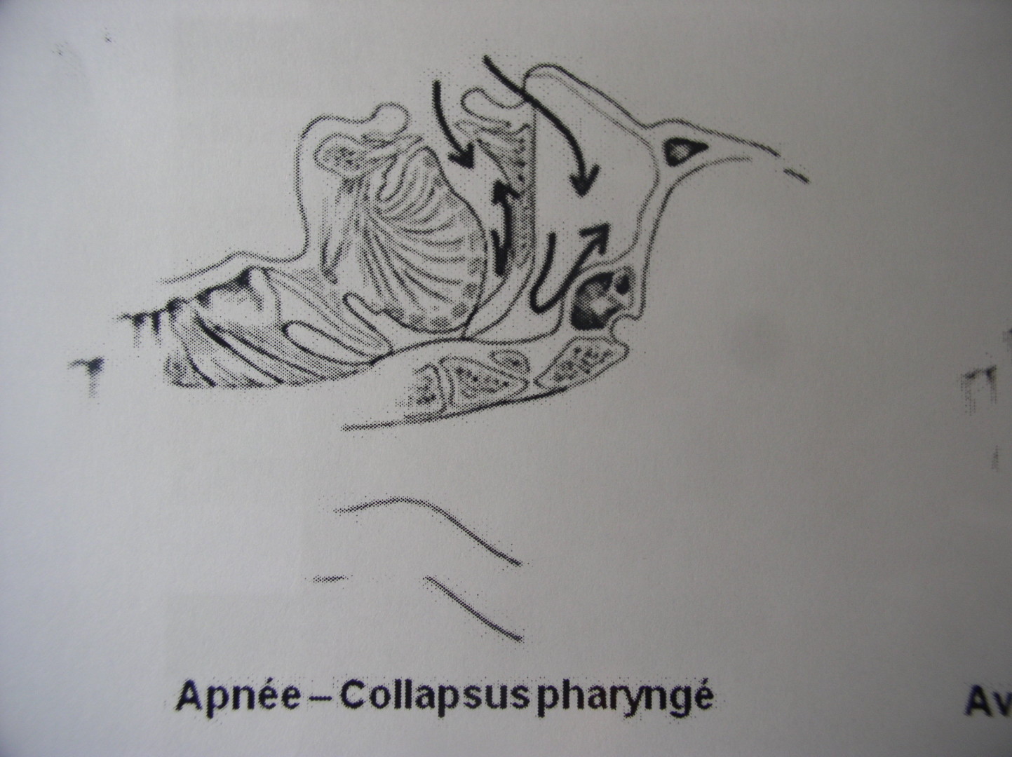 apnee-collapsuspharynge