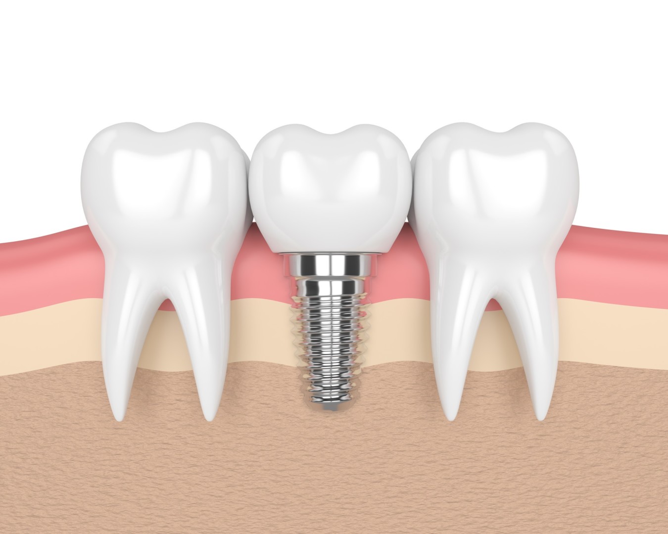 Schéma implant dentaire et dent